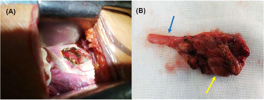 Figure 3: Intraoperative view, by right video-assisted mini-thoracotomy, after the resection of the ectopic parathyroid adenoma (A). Macroscopic appearance of the resected specimen (B): parathyroid adenoma (yellow arrow) and right thymic horn (blue arrow).