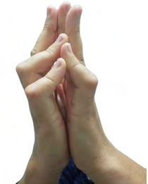 Figure 1: Our patient has flexion retraction of the fingers in Dupuytren’s disease.