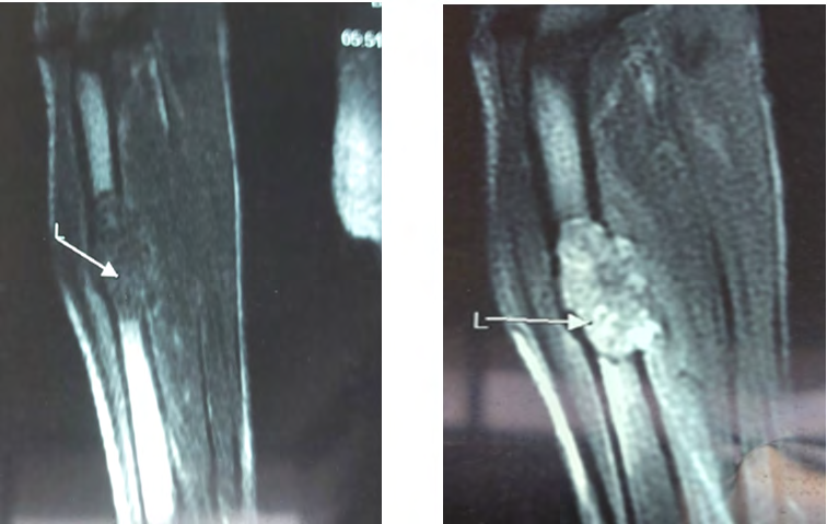 Figure 2: Secondary location on MRI of the right forearm.