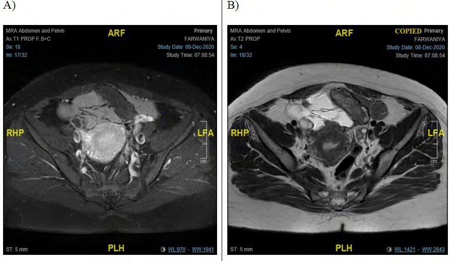 Figure 2: ** MRI showing multi-loculated peritoneal cystic lesions.