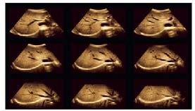 Figure 1: Normal liver. Liver shown in a nine-on-one format from a volumetric acquisition acquired in the axial plane, with the center point on the long axis of the portal veins at the porta hepatis [13].