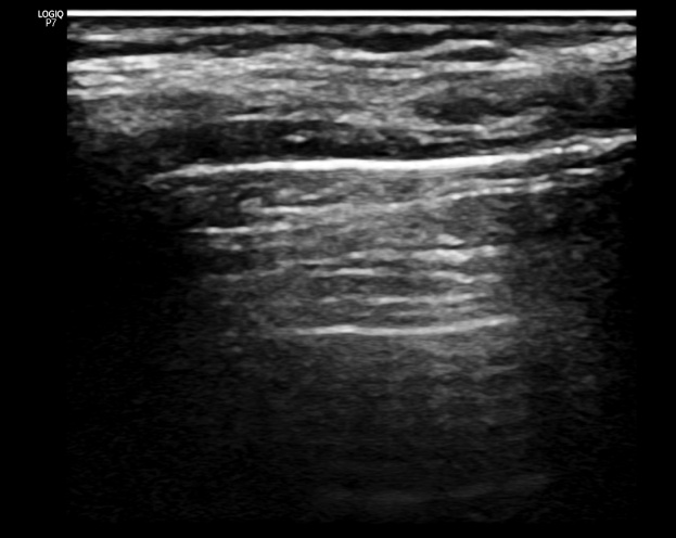 Figure 1: A lines - spread through aerated lung parenchyma, parallel to the pleural line and always at the same distance from the pleural line.