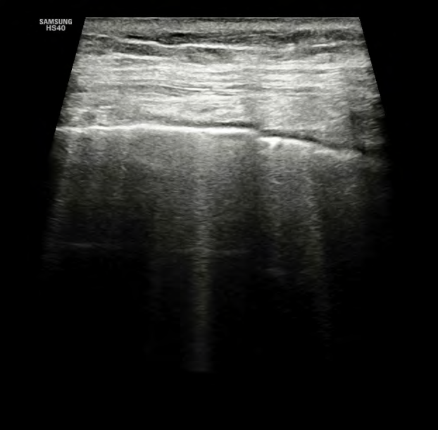 Figure 2: B lines extend from pleural line to the bottom and interrupt A lines.