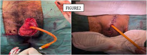 Figure 2: Per-operative aspect of hemostasis control and catheterization of the urethra.