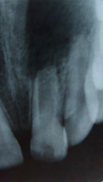 Figure 1: Periapical radiograph showed the periapical lesion before treatment.