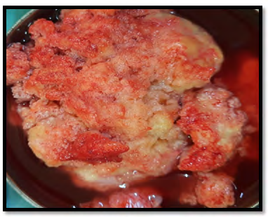 Figure 2: Gross appearance of the mass.