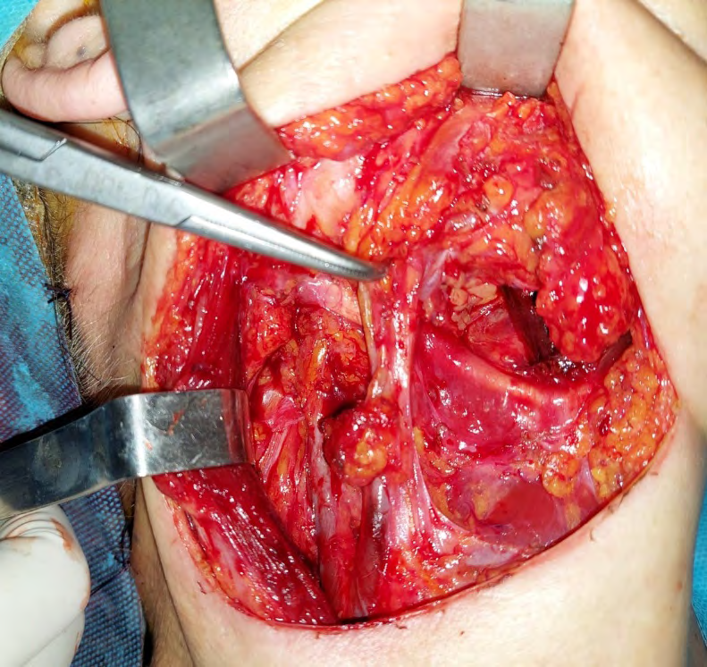Figure 2: CT: axial: irregularity is observed in the anterior and lateral sectors of the right mandible (arrow).