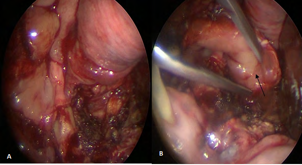 Figure 5: Buccinator myomucosal flap with antero-inferior pedicle.