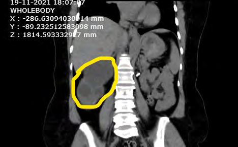 Figure 1: Multiple hepatic cysts in the right kidney.