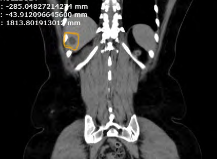Figure 2: Hepatic Cyst.