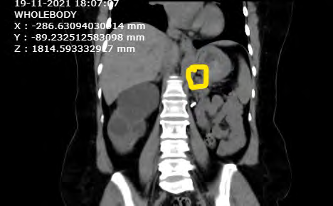 Figure 3: Adrenal cyst- Pheochrom Ocytoma.