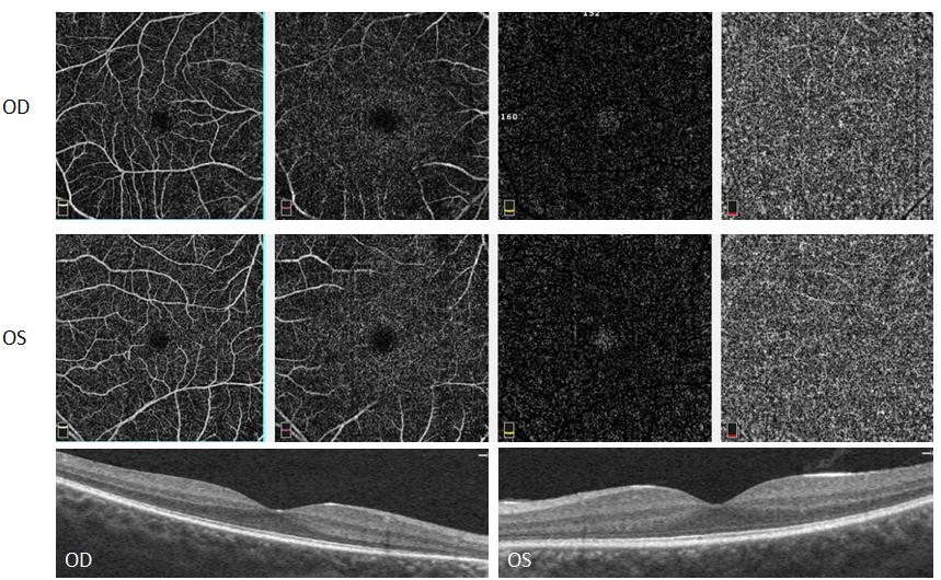 Figure 1: OCT Angiography and SD-OCT of the right and left eye of a patient with mild retinitis pigmentosa.