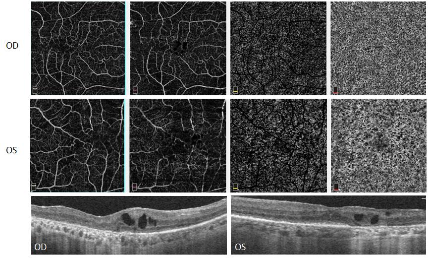 Figure 3: OCT Angiography and SD-OCT of the right and left eye of a patient with advanced retinitis pigmentosa.