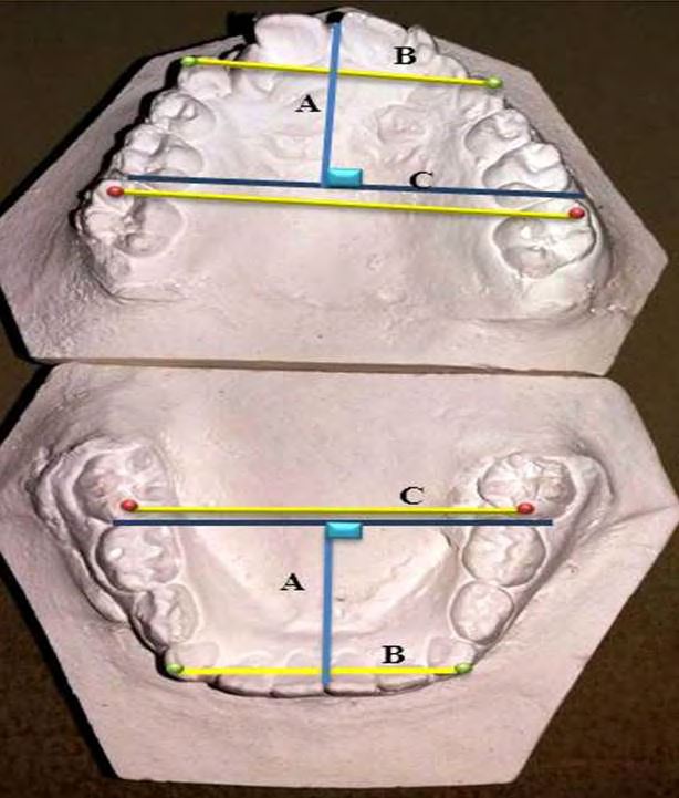 Figure 1: Dental Arch Dimensions: A. Arch Depth, B. Inter- canine Arch Width, C. Inter-molar Arch Width.