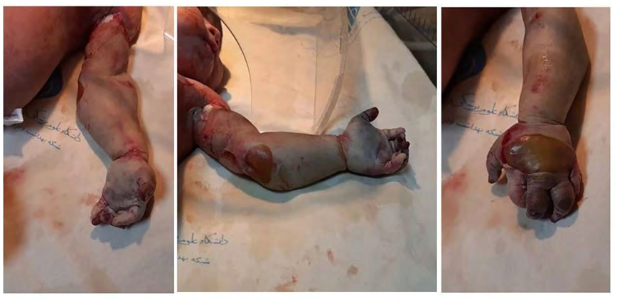 Figure 1: Before Amputation.