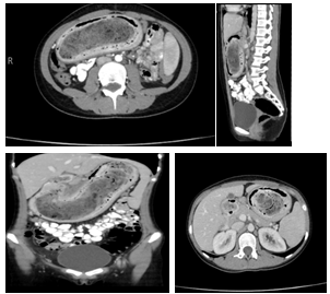 Figure 1: Abdominal and pelvic CT scan.