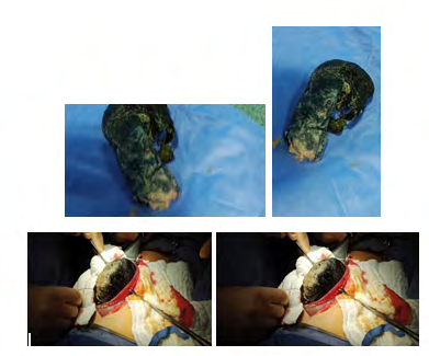 Figure 2: A) laparotomy and Gastrostomy. B) Specimen of extracted trichobezoar by gastrostomy: A hair cluster is observed adopting the gastric and 1st part of duodenum morphology.