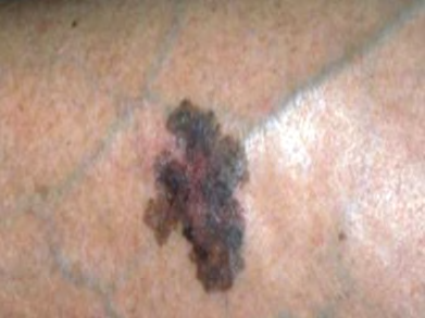 Figure 1: Superfacial spreading melanoma (Source [5]).