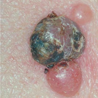 Figure 3: Nodular melanoma malignum (Source: [5]).