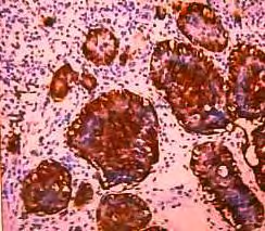 Figure 6: The tumor is positive for synaptophysin.