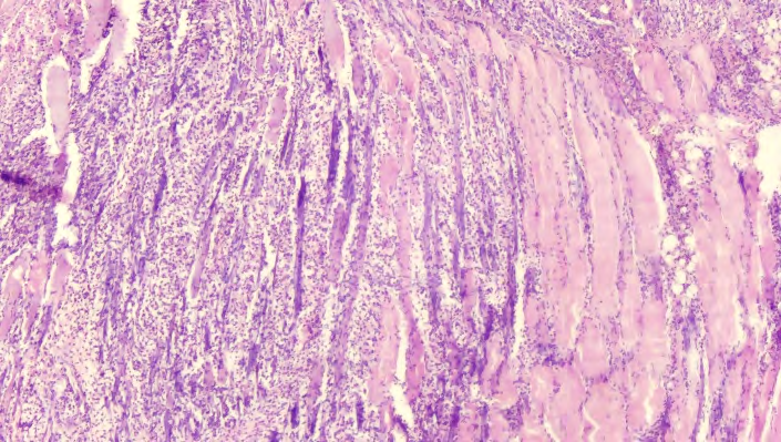 Figure 2: Diffuse leuko-lymphocytic inflammatory infiltration of muscles. Stained with hematoxylin and eosin. Ok.10. Ob.4