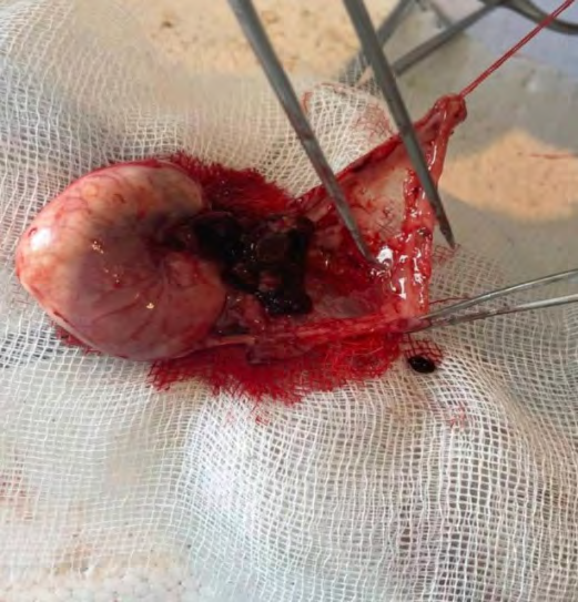 Figure 3: Necrosis of the spleen tissue and adjacent fatty tissue. Stained with hematoxylin and eosin. Ok.10. Ob.4 The conducted morphological studies have shown that with subcutaneous localization of the spleen autograft, pronounced alterative changes with necrosis of the spleen are noted. Pronounced inflammatory changes were revealed in the surrounding tissues. Given this fact, we decided to refrain from further continuation of experimental studies with the localization of spleen fragments in the subcutaneous tissue.