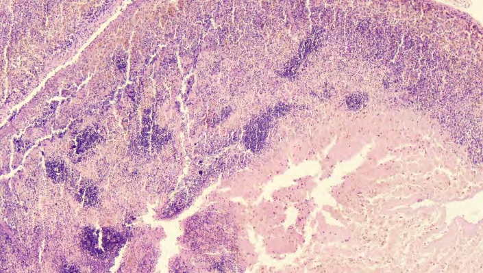Figure 7: Infiltrative adhesive process of the greater omentum around the tissues of the spleen. Stained with hematoxylin and eosin. Ok.10. Ob.4.