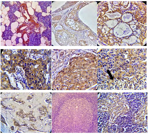 Figure 1: Maspin expression in salivary mucoepidermoid carcinoma. A: normal ductal epithelium in tissue adjacent tumor, showing positive maspin immunoreaction (20x); B: low grade MEC showing macrocystic spaces >25% (20x); C: Higher magnification of the previous case, revealing high cytoplasmic level of maspin (40x); (D): high grade MEC, cytoplasmic and secreted maspin (40x); E: high grade MEC with a solid area showing both nuclear and cytoplasmic pattern of maspin expression (40x); F: maspin expression localizes cell membrane (arrow) of mucous-secretory cells (40x). G: small nest of tumor cell express maspin in high grade MEC (20x). H: lymph node metastasis of MEC (20x). I: maspin overexpression in lymph node associated to MEC (20x).
