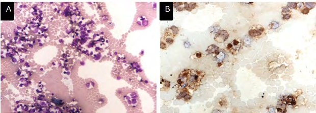 Figure 2: (A) FNAC smear slides stained with May-Grunwald Giemsa (MGG) stain and examined under 400× magnification showed a malignant round cell tumor present singly and in small clusters. (B) Tumor cells were strongly positive for synaptophysin on IHC staining.
