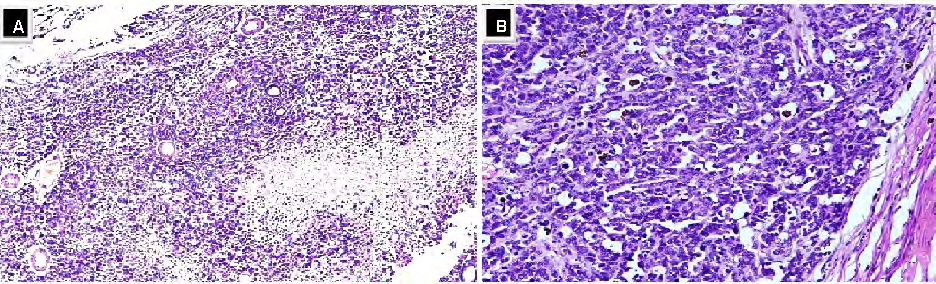 Figure 3: Histopathological sections of the enucleated eyeball stained with Haematoxylin and Eosin; (A) under 10x magnification. (B) Under 20x magnification, showed the presence of poorly differentiated retinoblastoma with extensive necrosis. The tumour was seen to be infiltrating the choroid, iris, ciliary body, inner sclera and entire optic nerve stump including the resected margin of the optic nerve.
