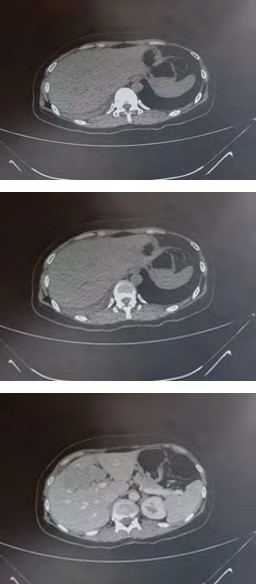 Figure 1: This figure is of multiple phases of a contrast enhanced triphasic liver CT scan. Figures A – F show an axial view of different levels of the liver. A contrast enhanced lesion can be seen at the common bile duct.