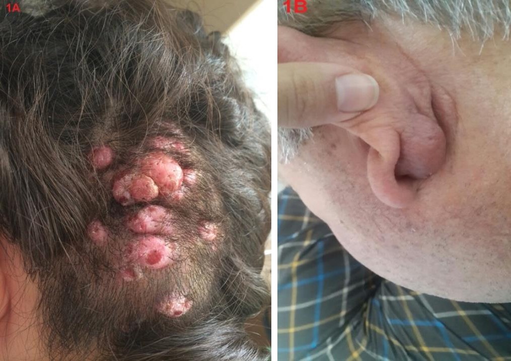 Figure 1: A: In Case 1, has a diameter of 0.5 x 2 cm, a grubed, erythematous, and some erode nodosites on the left occipital region; B: In case 2, behind the left ear 0.8 x 2 cm diameter one nodosity.