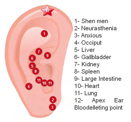Figure 10: Ear points used in the treatment to rebalance the internal energy of patients with chronic interstitial cystitis and recurrent urinary tract infections symptoms.