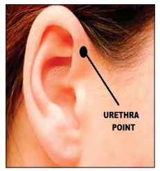 Figure 2: Bloodletting in the Bladder point in the helix of the ear.