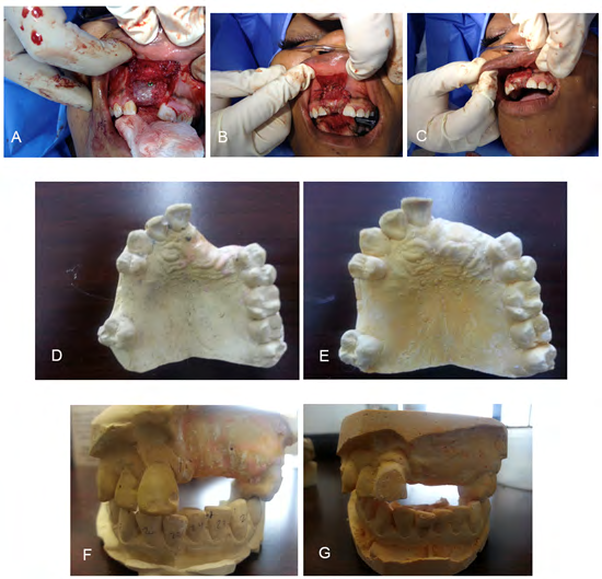 Figure 1: A. Placement of BMA impregnated freeze dried corticocancellous. B and C. Modified Lip-Switch technique to obtain primary closure over the BMA impregnated graft. D. Occlusal view of deficient anterior alveolar ridge preop. E. Occlusal view of anterior alveolar ridge 4 months after placement of BMA impregnated freeze dried corticocancellous. F. Facial view of deficient anterior alveolar ridge preop. G. Facial view of anterior alveolar ridge 4 months after placement of BMA impregnated freeze dried corticocancellous Figure 2 shows preop and postop conebeam CT measurements for subjects 1 and 2. The mean increase in alveolar ridge height of each of the subjects were measured at 4 months after treatment and were similar to established controls using traditional autogenous harvesting sites: 3.9 mm and 3.8 respectively. The mean increase in alveolar ridge width of each of the subjects were measured at the crest of the ridge were similar between both established autogenous, allogeneic as compared to our bone marrow aspirate groups: 4.33, 4.56 and 3.97 respectively. Seven of the 10 patients have received dental implants which have remained osseointegrated at least 1-year post-implantation.