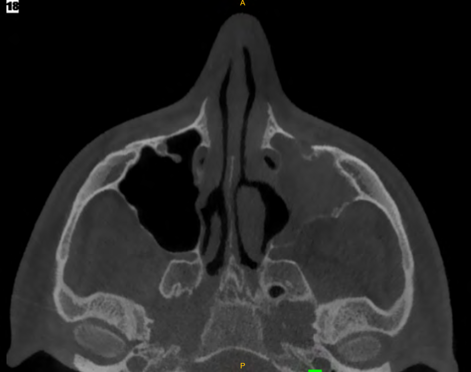 Figure 2: Axial CT displaying left sided Silent Maxillary Sinus Syndrome with protrusion of the posterior wall of the maxillary sinus denoting herniation of the pterygopalatine fossa fat.
