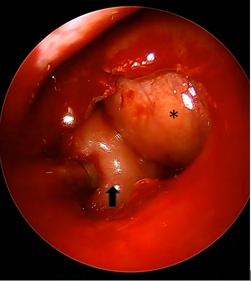 Figure 3: Finally, a polypoid degeneration of the head of the ipsilateral middle turbinate was resected and the sphenopalatine artery was located behind the ethmoid crest and cauterized. The patient was discharged on the same day, without nasal tamponade.