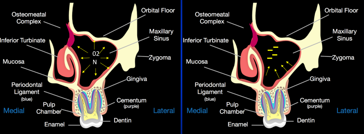 Figure 4: Pathogenesis of the Silent Sinus Syndrome: Ostiomeatal complex obstruction due to uncinate process atelectasis with absorption of 02 and N with negative pressure generation.