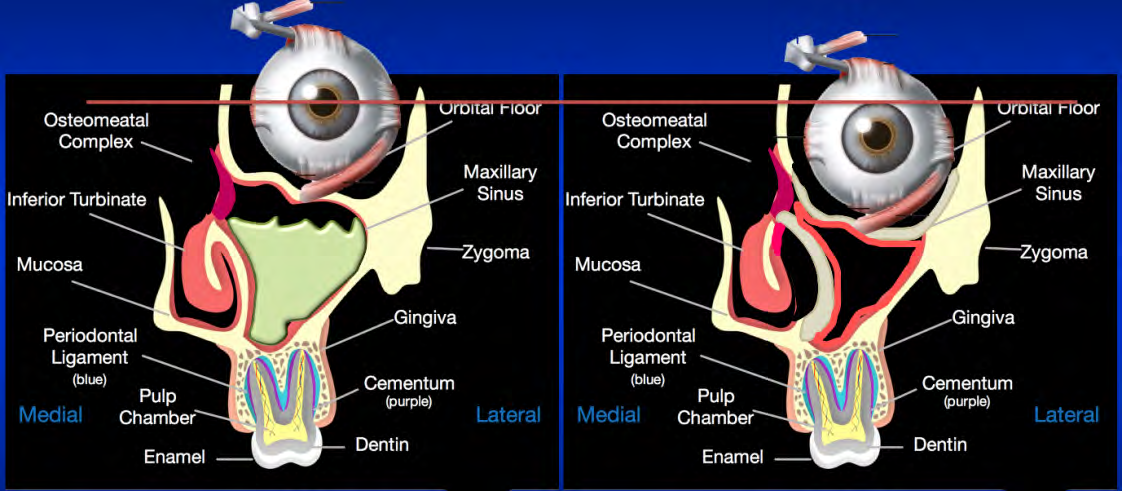 Figure 5: Pathogenesis of the Silent Sinus Syndrome part 2: effusion inside the maxillary sinus due to negative pressure (left). Volumetric reduction of the sinus with orbital floor sinking and lateral wall of the nasal fossa atelectasis (right).