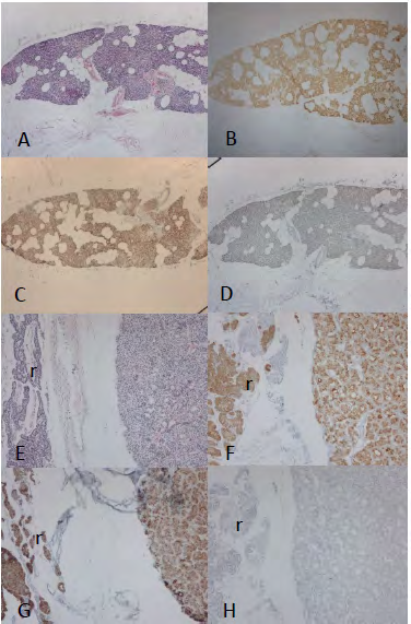 Figure 1: Normal Parathyroid and Parathyroid Adenoma.