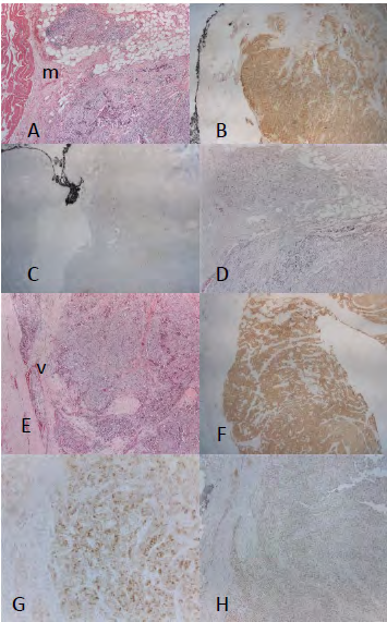 Figure 3: Primary and Metastatic Parathyroid Carcinoma.