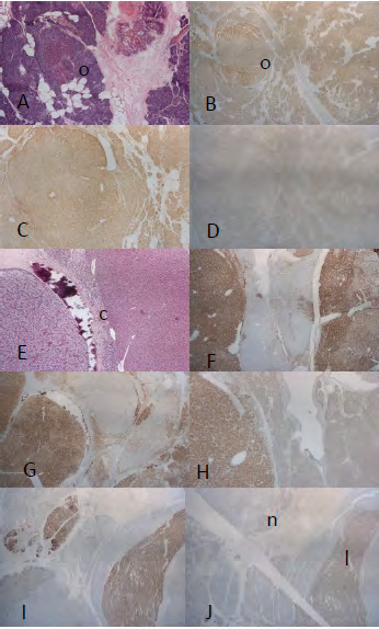 Figure 4: Hyperplasia: Small Gland and Large Gland.