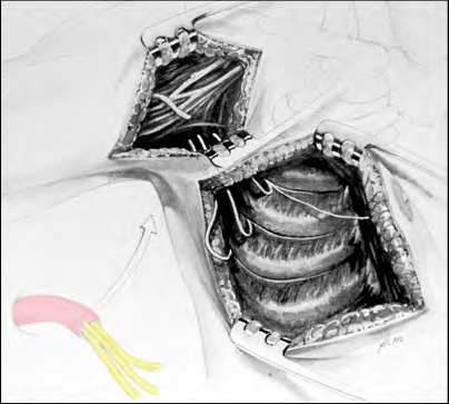 Figure 1: Habitual Technique of open dissection of intercostal nerves and neurotization with the musculocutaneous nerve.