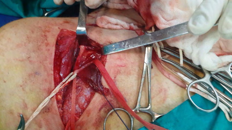 Figure 4: Identification of the musculocutaneous nerve at the infraclavicular level.