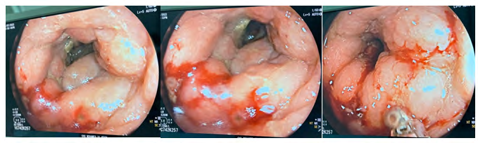 Figure 2: Endoscopic view of a ulcero-budding lesion reducing the colonic lumen.