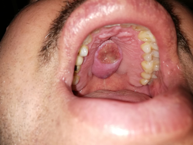 Figure 1: Ulcerative mass at the hard palate.