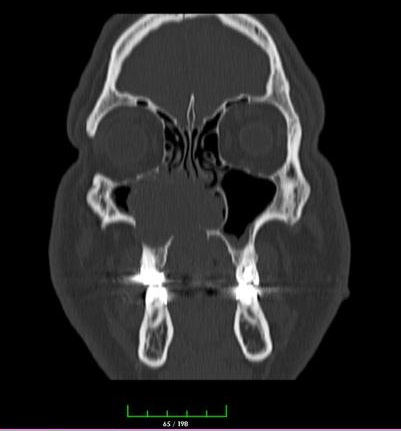 Figure 2: CT revealing a mass extending from oral cavity to the nasal cavity and maxillary sinus.