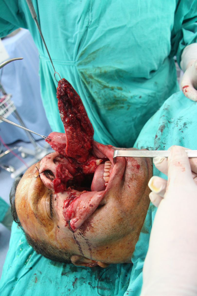 Figure 3: Intraoperative view of the angular artery-based flap after tunneling under the upper lip.