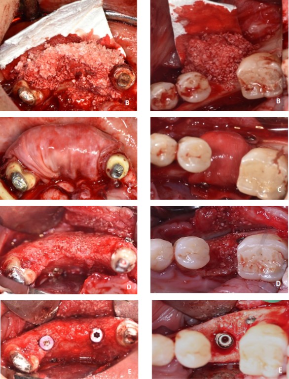 Figure 2: NonCL group. A: Pre-operative ridge. B: Membrane fixation and bone graft addition. C: Membrane fixation. D: Ridge at implant placement surgery. E: Implant placement [24].