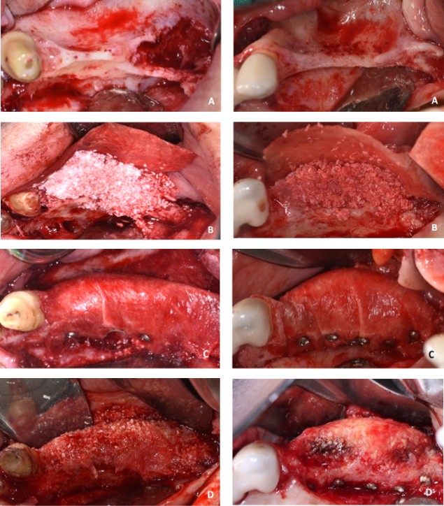 Figure 3: CL group. A: Pre-operative ridge. B: Membrane fixation and bone graft addition. C: Membrane fixation. D: Ridge at implant placement surgery. E: Implant placement [25].